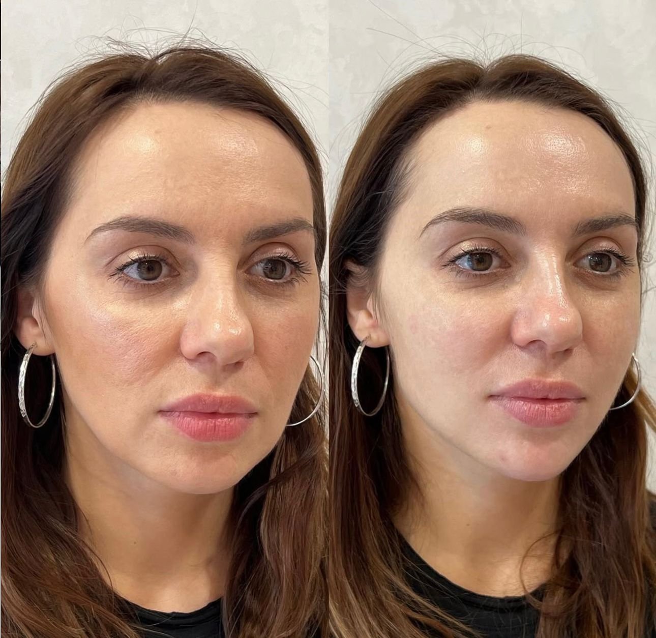 Antes e Depois — Harmonização Facial Premium