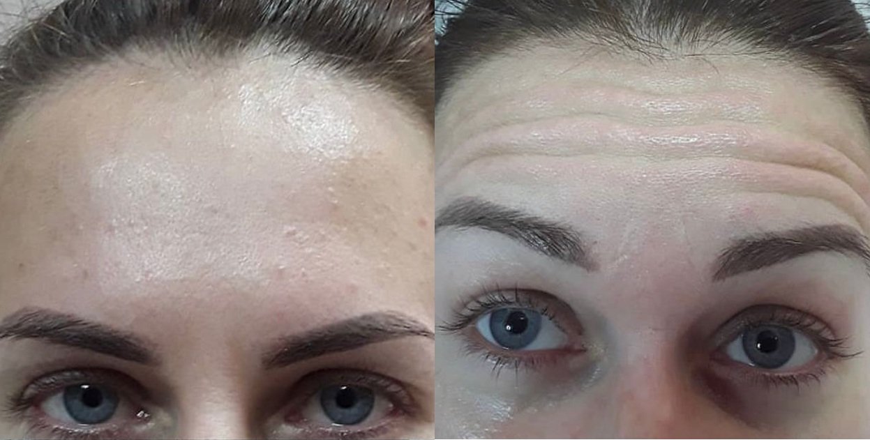 Antes e Depois — Suavização de Linhas de Expressão
