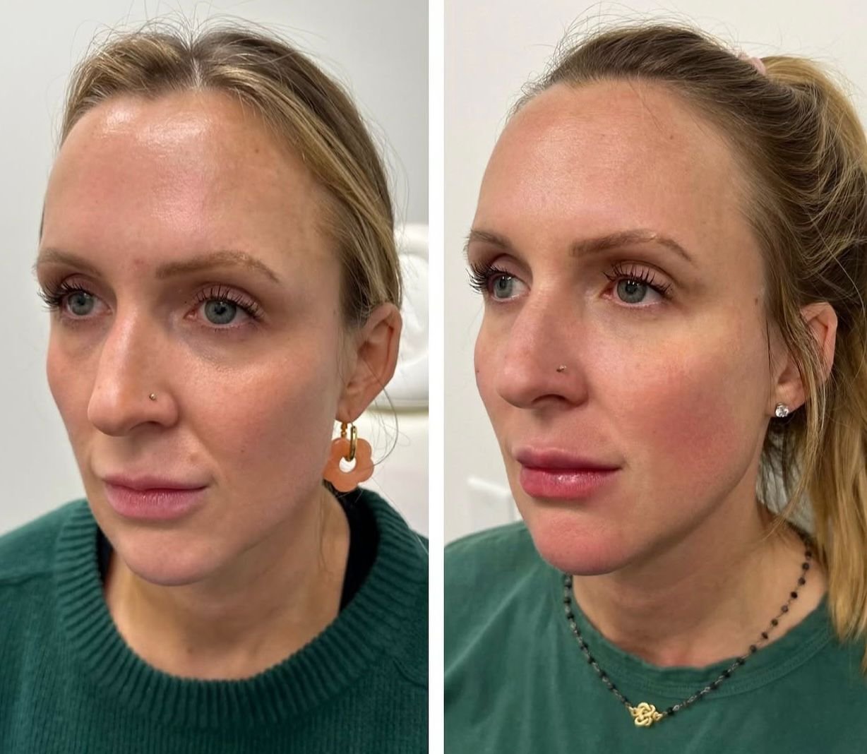 Antes e Depois — Harmonização e Preenchimento