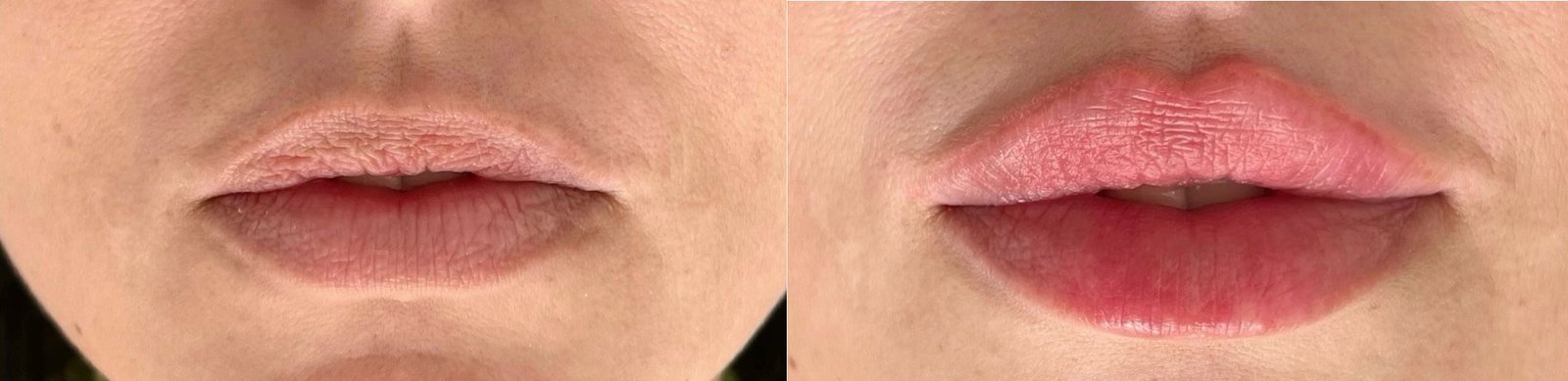 Antes e Depois — Preenchimento Labial Premium
