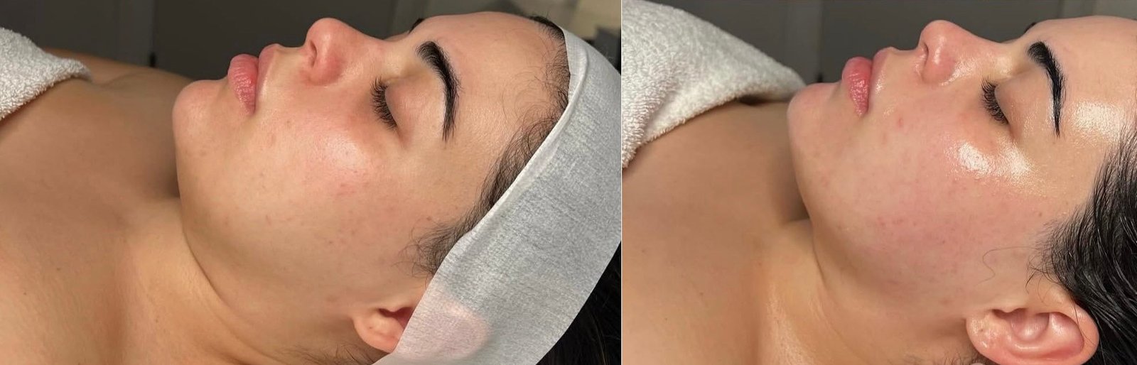 Antes e Depois — Renovação de Pele